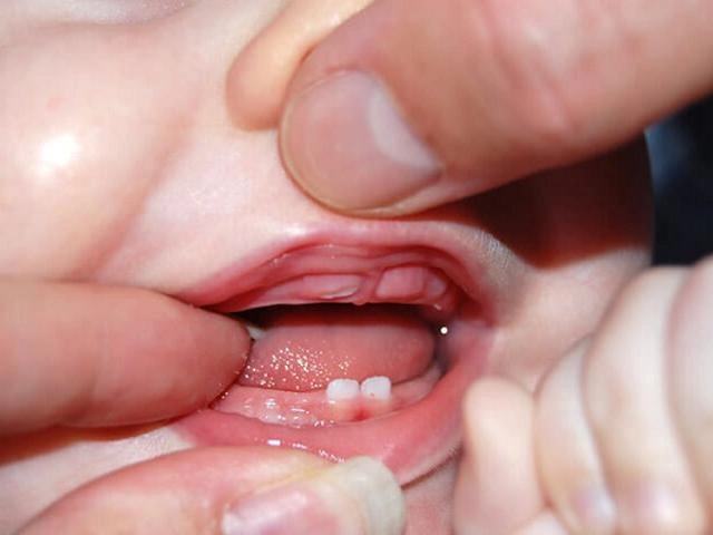 Trẻ sốt mọc răng biểu hiện và cách chăm sóc răng cho trẻ - 3