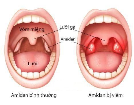 Viêm amidan cấp ở trẻ nguyên nhân triệu chứng và cách điều trị - 1