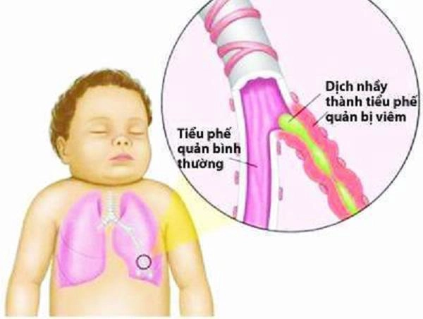 Viêm phổi ở trẻ em nguyên nhân và cách điều trị do bác sĩ hướng dẫn - 2