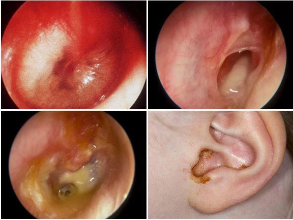 Viêm tai giữa ở trẻ em dấu hiệu và cách điều trị bệnh cấp tính cho bé - 1