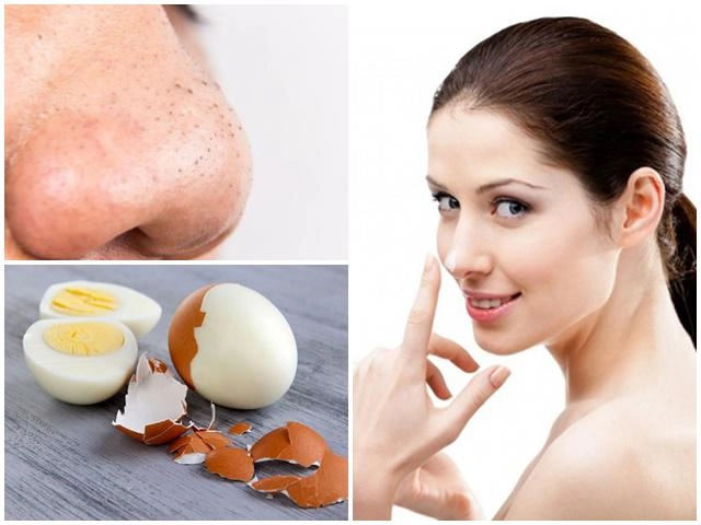 10 cách trị mụn đầu đen ở mũi má trán an toàn hiệu quả nhanh nhất - 14