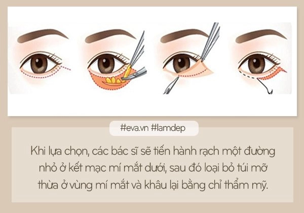 Bỏ túi ngay những kiến thức này nếu không muốn trở thành thảm họa sau cắt bọng mỡ mắt - 4