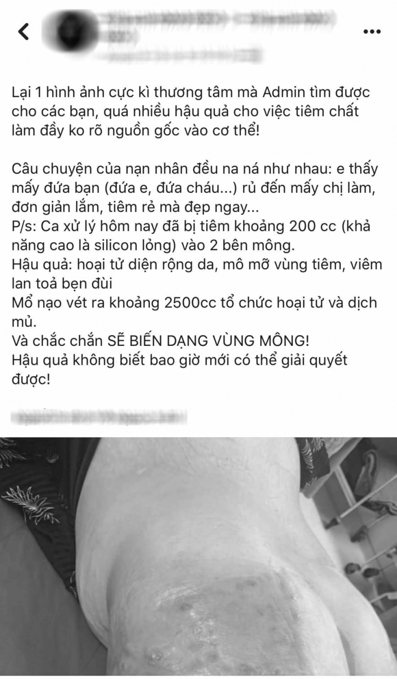 Chuyện cô gái bị hoại tử nặng nề vùng mông do tiêm filler và lời cảnh tỉnh của bác sĩ - 1