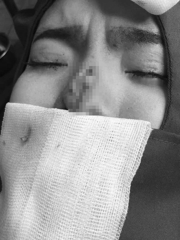 Cô gái bị bục da mũi lộ hết sụn độn hậu nâng mũi đâu là bài học cho chị em - 3