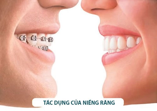 Niềng răng thẩm mỹ và những điều bạn nên cần biết - 2