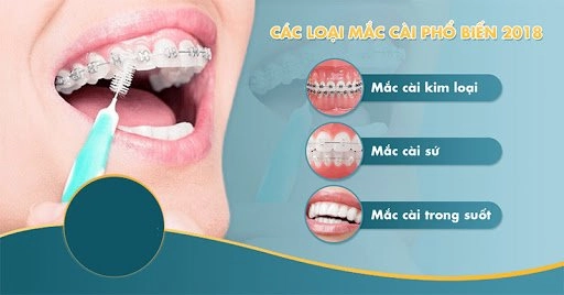 Niềng răng thẩm mỹ và những điều bạn nên cần biết - 3