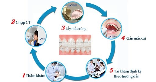 Niềng răng thẩm mỹ và những điều bạn nên cần biết - 4