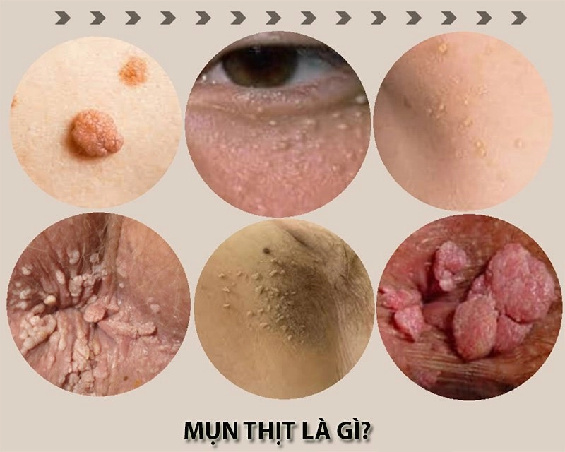 15 cách trị mụn thịt tận gốc quanh mắt và vùng cổ tại nhà an toàn hiệu quả nhất - 1