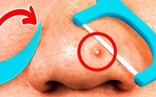 8 cách trị mụn trứng cá tại nhà bằng thiên nhiên hiệu quả - 1