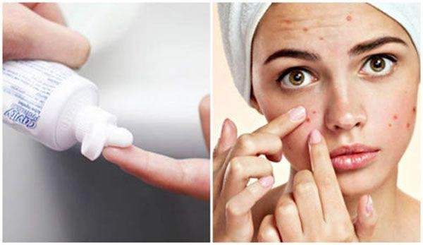 8 cách trị mụn trứng cá tại nhà bằng thiên nhiên hiệu quả - 4