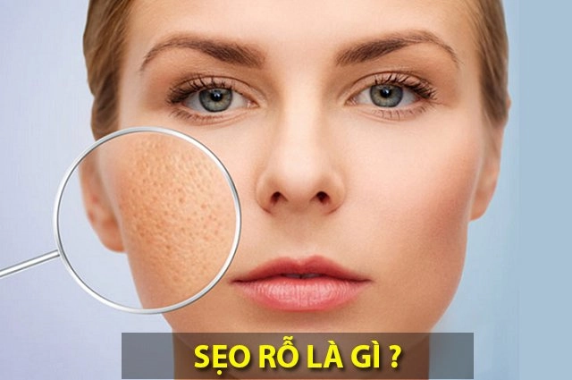 Cách trị sẹo rỗ lâu năm an toàn hiệu quả nhất từ nguyên liệu dễ kiếm - 1
