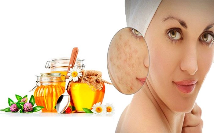 Cách trị sẹo rỗ lâu năm an toàn hiệu quả nhất từ nguyên liệu dễ kiếm - 4