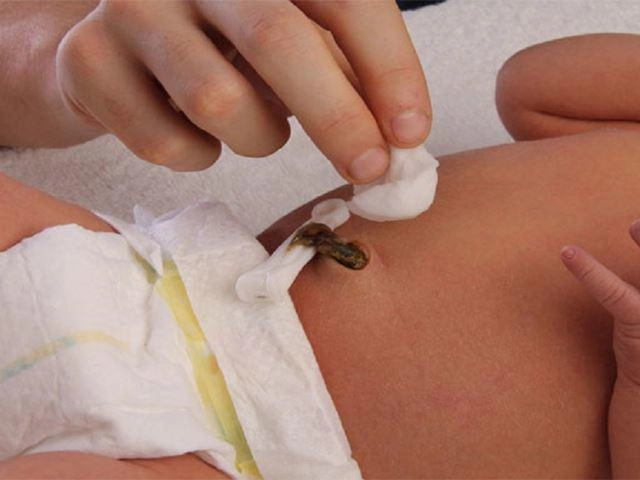 Chăm sóc trẻ sơ sinh rụng rốn nhưng chưa khô - 4