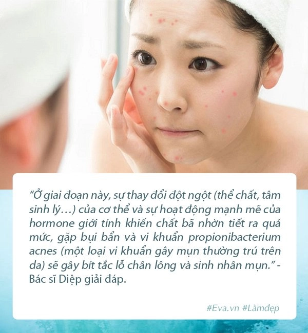 Cùng con đối phó với mụn dậy thì mẹ đừng bỏ qua loạt lời khuyên của chuyên gia - 3