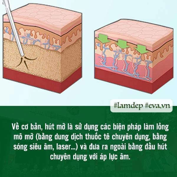 Giảm cân thần kỳ bằng phương pháp hút mỡ liệu trên đời thực sự có phép màu đó - 3
