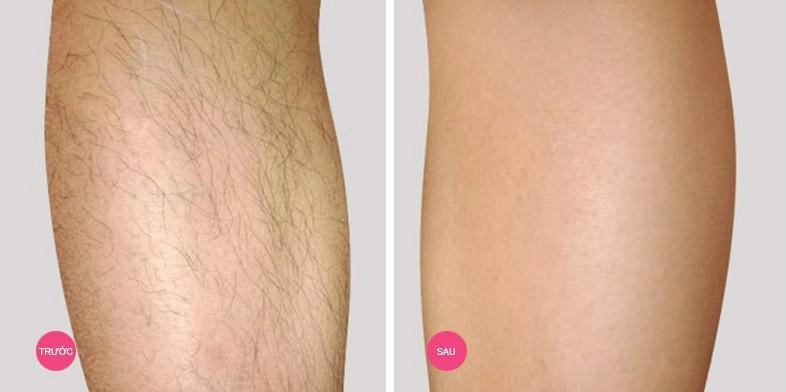 Hè rồi đi biển chẳng dám mặc bikini vì chân nhiều lông hãy áp dụng ngay 2 công thức này - 1