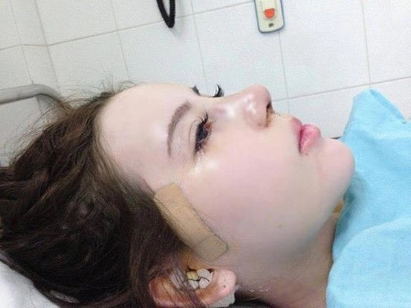 Hết độn cằm độn ngực giờ đến độn thái dương hiệu quả chưa biết nhưng hậu quả đã thấy rồi - 2