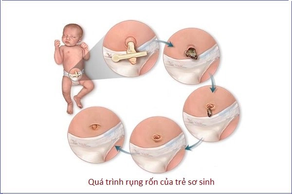 Hình ảnh rốn trẻ sơ sinh bị nhiễm trùng khiến nhiều mẹ sửng sốt - 6