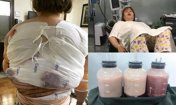 Hút 8 lít mỡ xong đâu lại vào đấy hotgirl trăm ký gây thất vọng bởi body hệt hồi 127kg - 3