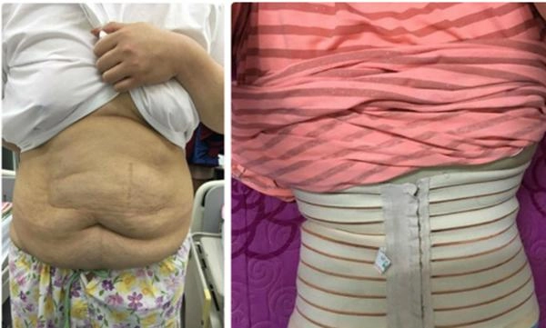 Hút 8 lít mỡ xong đâu lại vào đấy hotgirl trăm ký gây thất vọng bởi body hệt hồi 127kg - 4