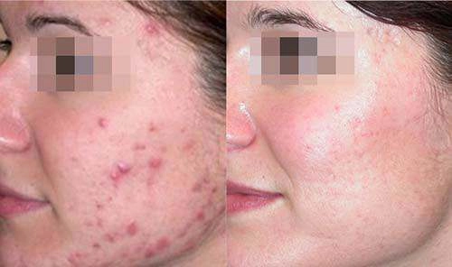 Lần nào makeup xong cũng bị nổi mụn hãy áp dụng ngay 2 công thức dưới đây - 3