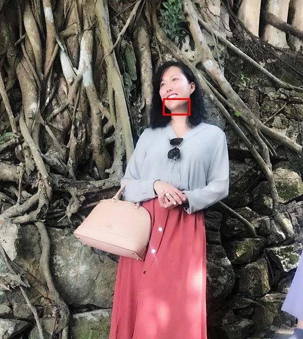 Mũi biến dạng cằm lệch một bên phi thanh vân đối diện với biến chứng sau nhiều lần dao kéo - 4