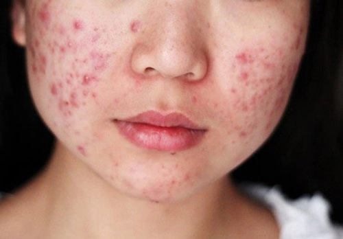 Mụn trứng cá mụn đầu đen gì cũng hết với 3 công thức chưa đến 10 ngàn đồng dưới đây - 1