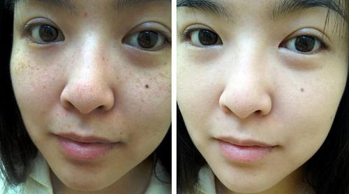 Nám nặng cỡ nào cũng biến mất nhờ 2 cách dễ ợt từ đu đủ xanh - 5