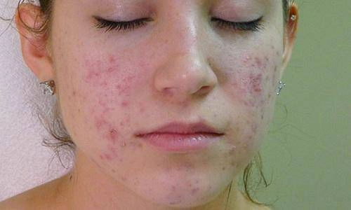 Ngày nào cũng skincare mụn vẫn mọc như nấm hãy áp dụng ngay 2 công thức dưới đây - 1
