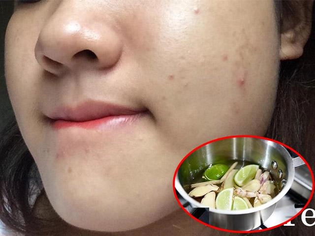 Ngày nào cũng skincare mụn vẫn mọc như nấm hãy áp dụng ngay 2 công thức dưới đây - 7