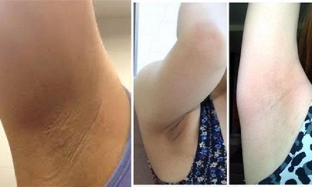 Ngoài vi-o-long da dưới vùng nách đen sạm sần sùi là do bạn chưa biết những điều này - 9