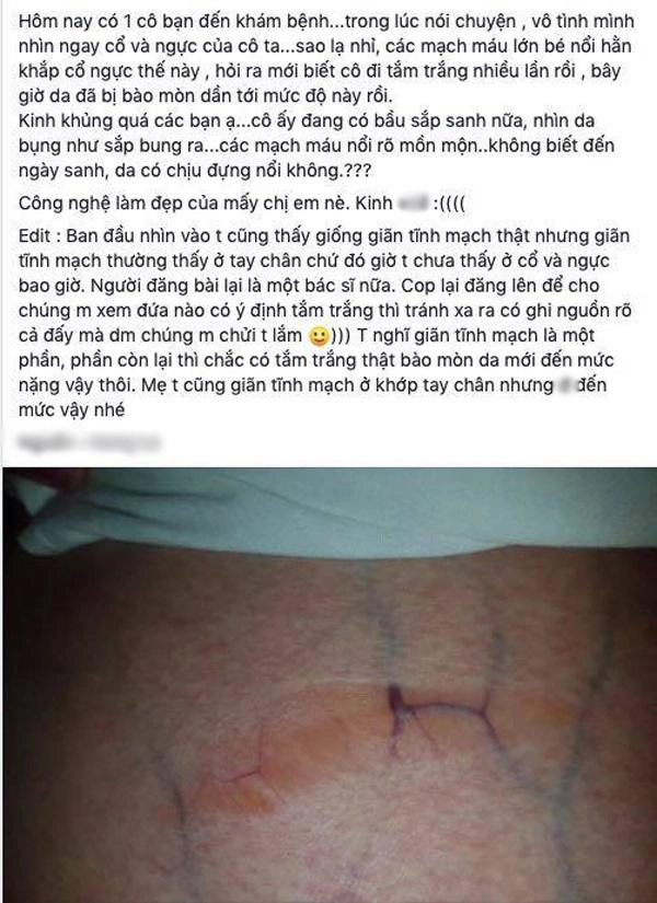 Người nổi đầy gân xanh như trong phim kinh dị tất cả là bởi phương pháp làm đẹp này - 2