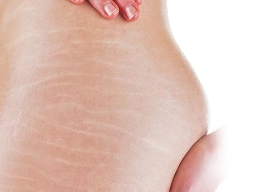 Rạn da đến mấy cũng mờ đi với công thức thần kỳ từ viên vitamin e và nha đam - 1
