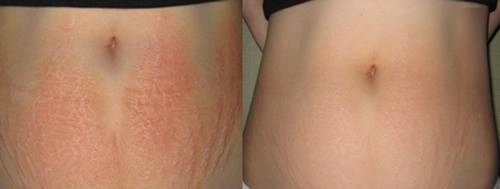 Rạn da đến mấy cũng mờ đi với công thức thần kỳ từ viên vitamin e và nha đam - 7