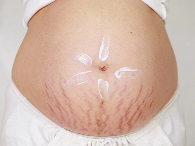 Rạn da đến mấy cũng mờ đi với công thức thần kỳ từ viên vitamin e và nha đam - 8