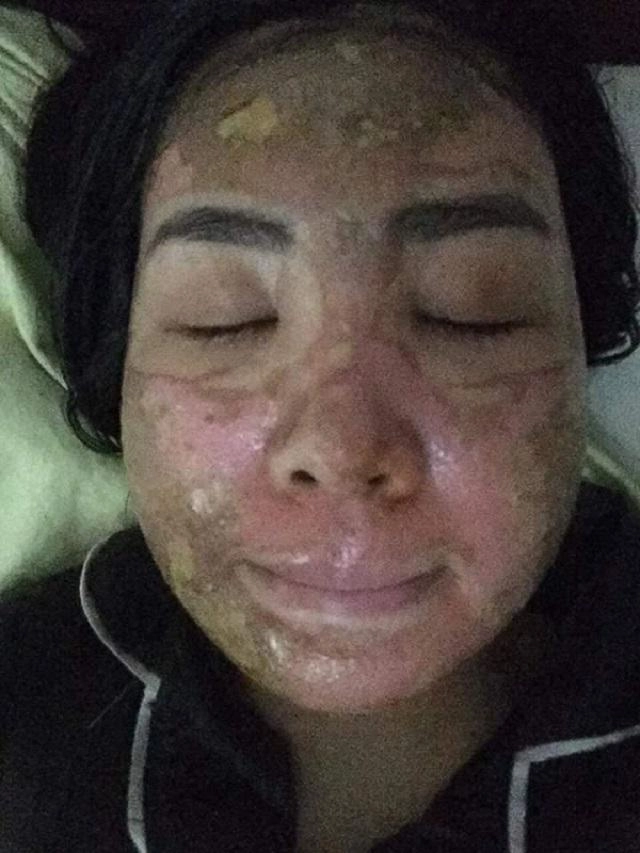 Sốc trước gương mặt của cô gái trẻ trước 15 ngày cưới khi tin vào mỹ phẩm xịn - 1