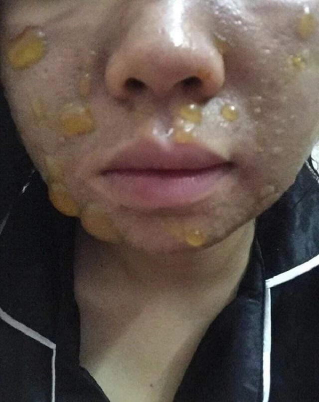 Sốc trước gương mặt của cô gái trẻ trước 15 ngày cưới khi tin vào mỹ phẩm xịn - 2