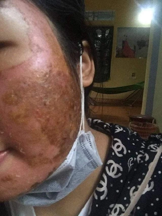 Sốc trước gương mặt của cô gái trẻ trước 15 ngày cưới khi tin vào mỹ phẩm xịn - 4