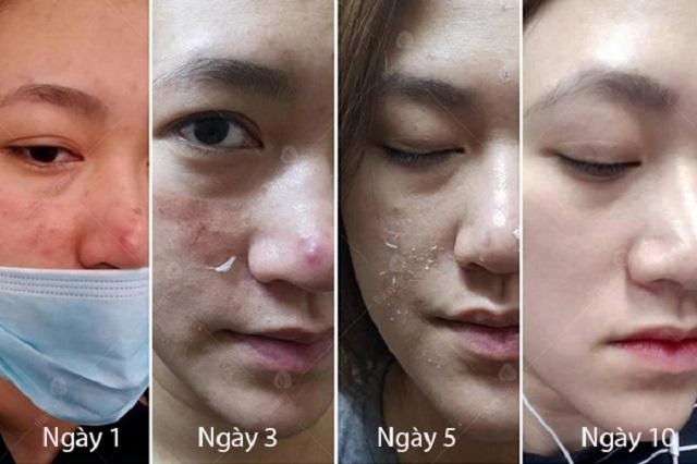 Sốc trước gương mặt của cô gái trẻ trước 15 ngày cưới khi tin vào mỹ phẩm xịn - 7
