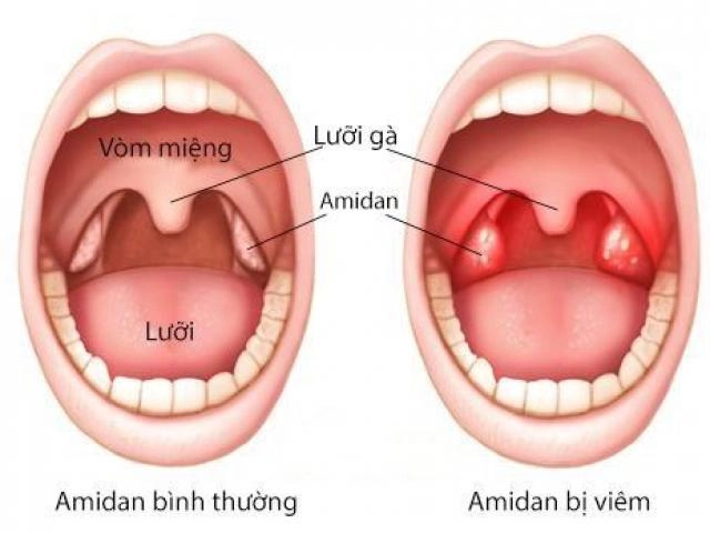 Trẻ bị viêm amidan sốt mấy ngày và cách hạ sốt do viêm amidan như thế nào - 4