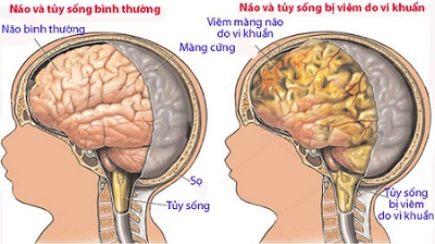 Triệu chứng quai bị ở trẻ em dễ nhận biết nhất - 4