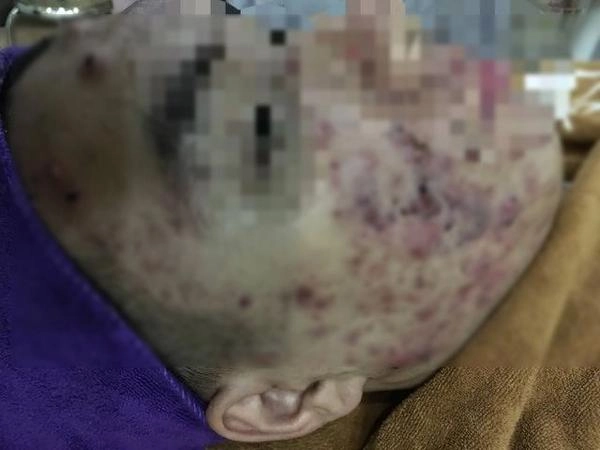 Tưởng da căng mịn sau lăn kim cô gái gây sốc toàn tập với khuôn mặt chi chít mụn mảng - 2