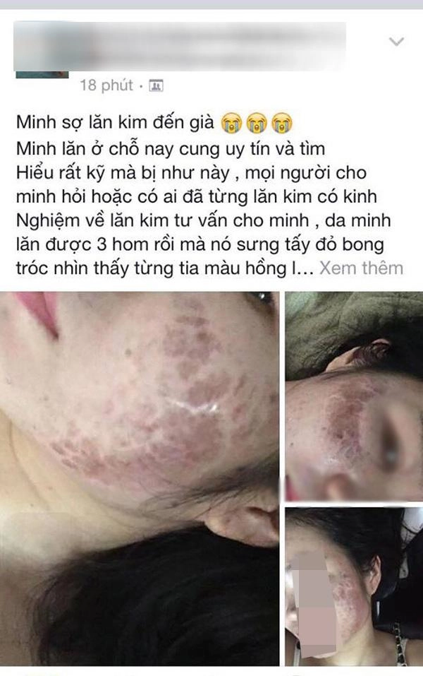 Tưởng da căng mịn sau lăn kim cô gái gây sốc toàn tập với khuôn mặt chi chít mụn mảng - 3