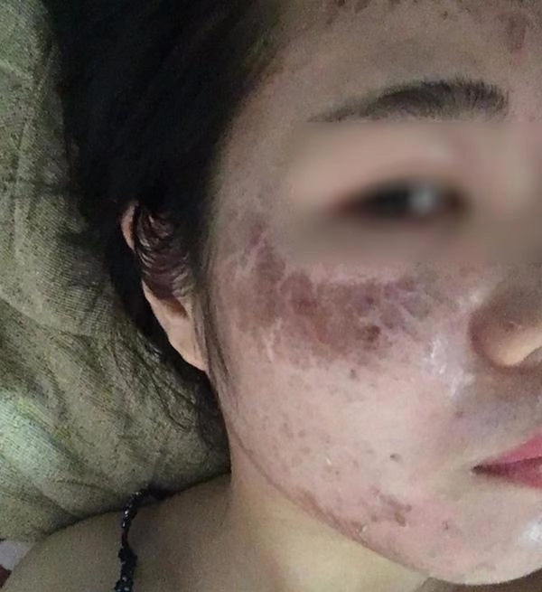Tưởng da căng mịn sau lăn kim cô gái gây sốc toàn tập với khuôn mặt chi chít mụn mảng - 4
