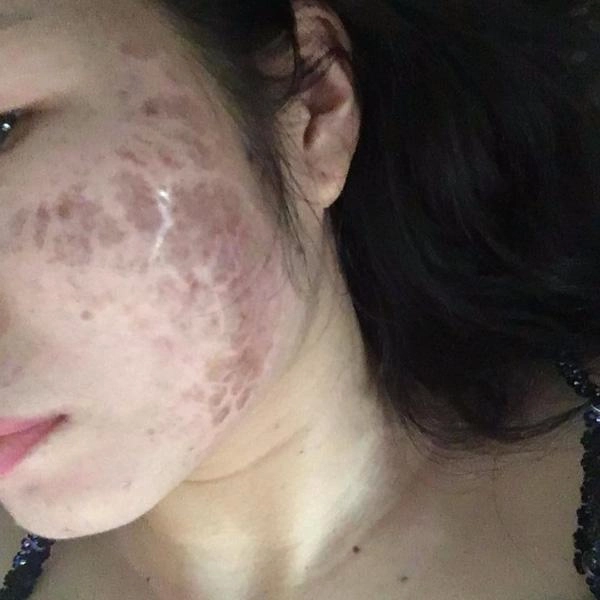 Tưởng da căng mịn sau lăn kim cô gái gây sốc toàn tập với khuôn mặt chi chít mụn mảng - 5