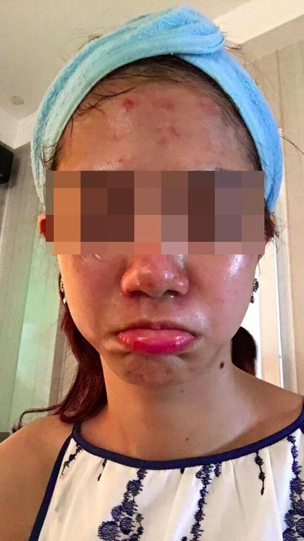 Tưởng da căng mịn sau lăn kim cô gái gây sốc toàn tập với khuôn mặt chi chít mụn mảng - 6