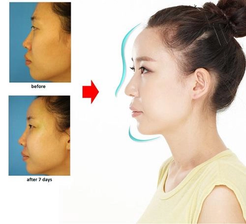 Xuất hiện với diện mạo khác lạ phải chăng lưu hương giang chạy theo trào lưu độn trán - 6