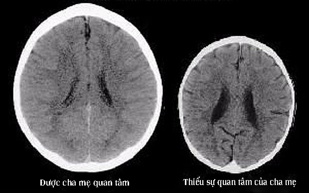 Nhìn trước tương lai bất hạnh của đứa trẻ bên phải qua ảnh chụp não bộ 2 bé 3 tuổi - 1