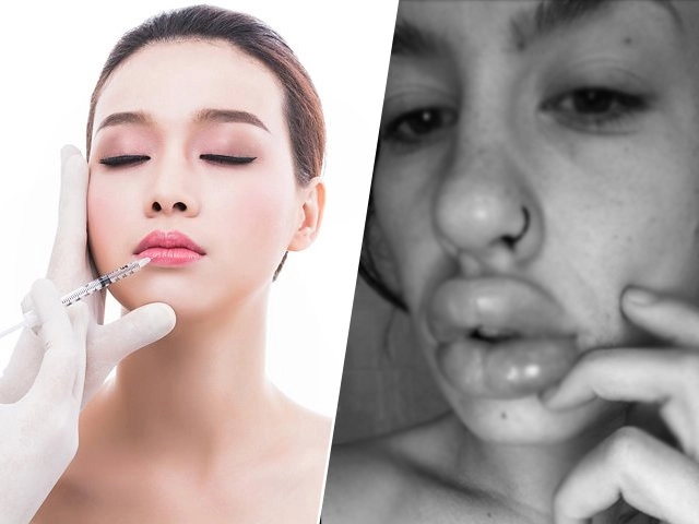 Bơm môi dày như cặp xúc xích chập đôi tiêu chuẩn đẹp của một số cô gái sao lạ quá - 14