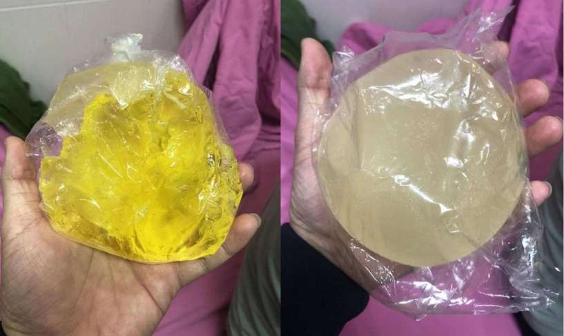 Người nổi tiếng từng gặp biến chứng sau dao kéo có người phải sống mãi với gương mặt đáng sợ - 4